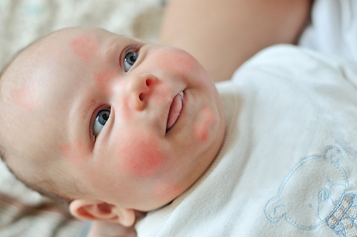 Allergies in Babies: Types, Symptoms, Treatment, Test and Complications ...