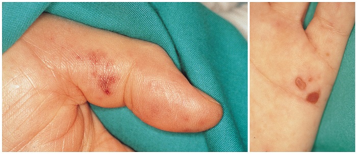 Bacterial or Infectious Endocarditis Symptoms and Treatment - Scope Heal