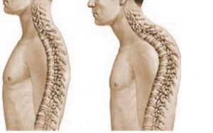 Hypercifosis: Symptoms, Diagnosis, Clinical Consequences, Causes and