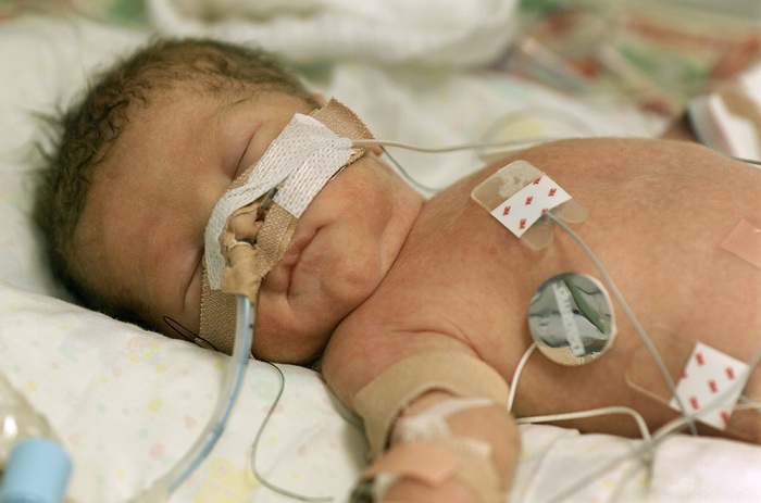 Hypoxic-Ischemic Encephalopathy in the Neonate - Scope Heal