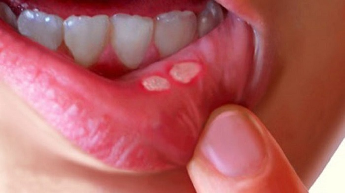 Can A Virus Cause Sores In Your Mouth