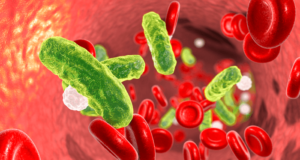 Septicemia: Definition, Causes, Symptoms and Treatment - Scope Heal