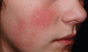 The Erythema: A Mysterious Disease - Scope Heal