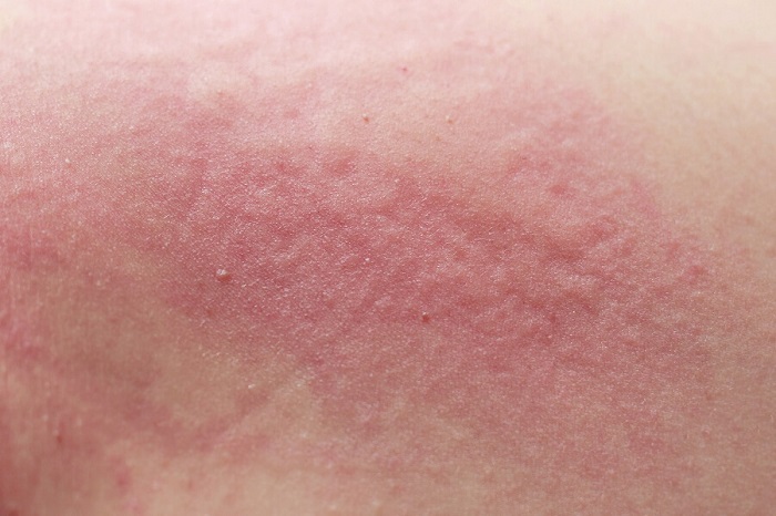 Cutaneous Candidiasis Causes Risk Factors Signs