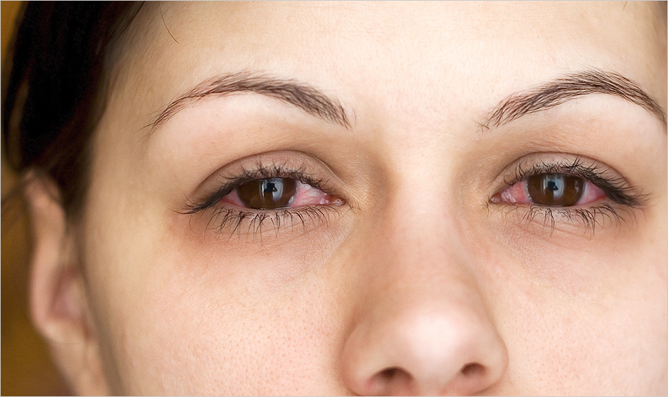 Uveitis Ocular Inflammatory Disease Types, Causes, Symptoms