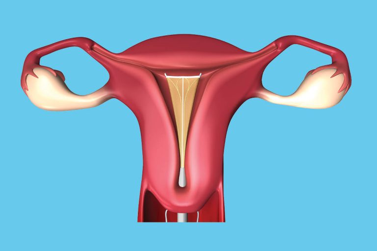Endometrial ablation What is it? Indications, Procedure, Risks