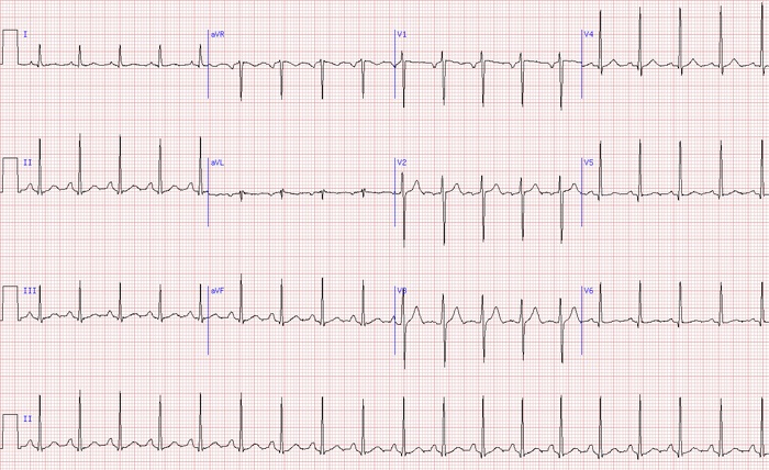 Sinus Tachycardia: Sinus Node, Causes, Symptoms and Persons Prone to ...